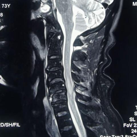 我科成功开展一例颈椎后路单开门椎管扩大成形术！