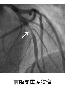 冠状动脉造影 及支架植入术