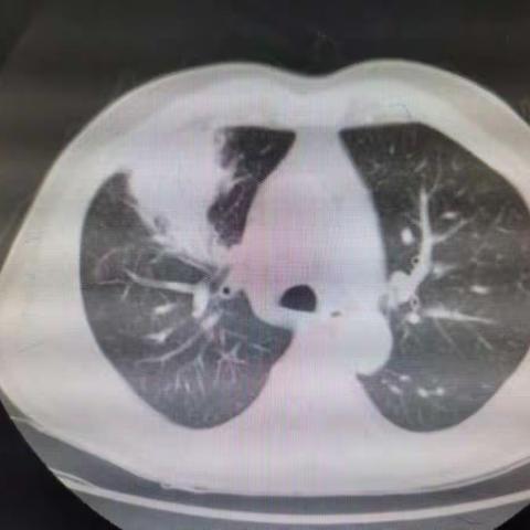 针尖上的舞蹈-肺穿刺活检