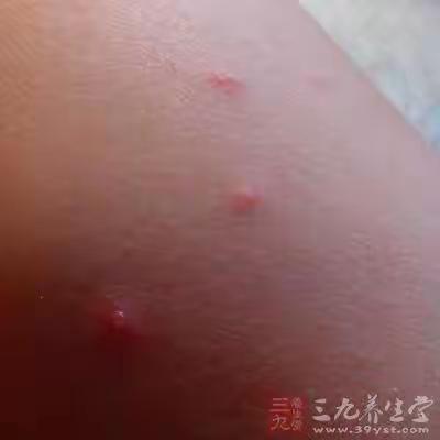 致家长的一封信——预防水痘，远离传染病