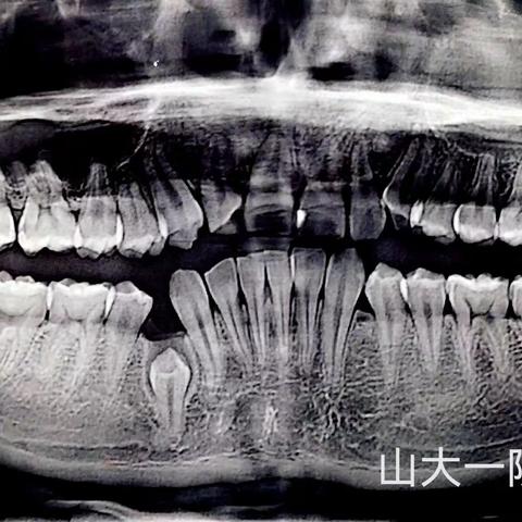 交城县医疗集团人民医院口腔科完成首例“多颗埋伏牙一次性微创无痛拔除”