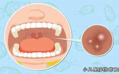 五六月高发的疱疹性咽峡炎，如何预防和调理？