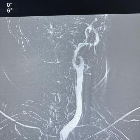 2022.11.9左侧颈内动脉