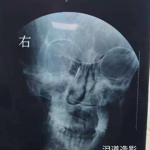 《息县人民医院耳鼻咽喉科》