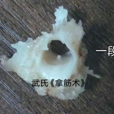 关于腱鞘炎的一点体会