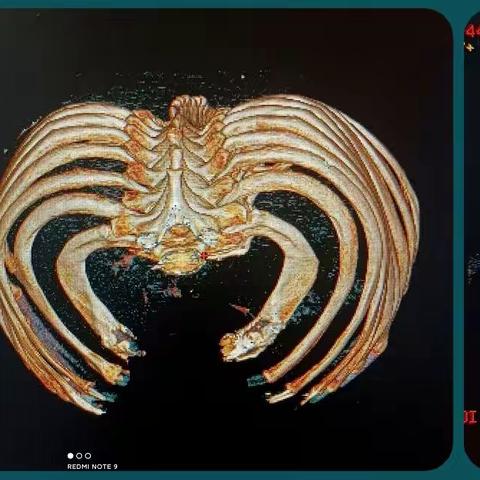 胸部外伤，为什么一定要做CT肋骨重建而不是单纯拍片！！