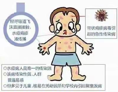 预防水痘，关注健康——千庄幼儿园卫生保健知识宣传