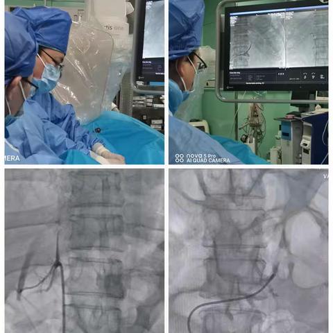 南阳首次，省内领先-肾上腺静脉取血术