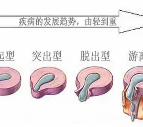 腰椎间盘臭氧髓核消融术