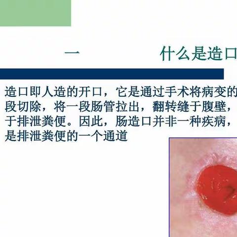 肿瘤外科患教——肠造口护理及宣教