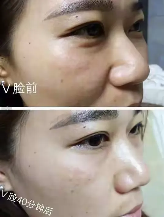 吉美能量v脸一款布料解决脸部所有的问题