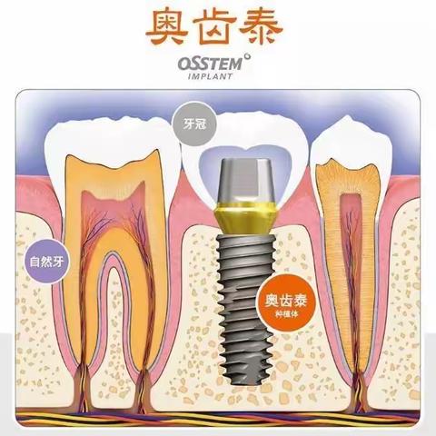 种植牙科普篇-韩国奥齿泰种植体