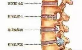 腰椎间盘突出症并不难治——4种理论+4种核心治疗