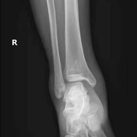 一例Maisonneuve（梅桑纳芙）骨折分享