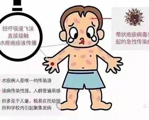 土默特左旗第二幼儿园水痘和诺如病毒预防小贴士