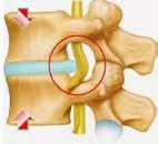 椎间盘突出能复位吗？