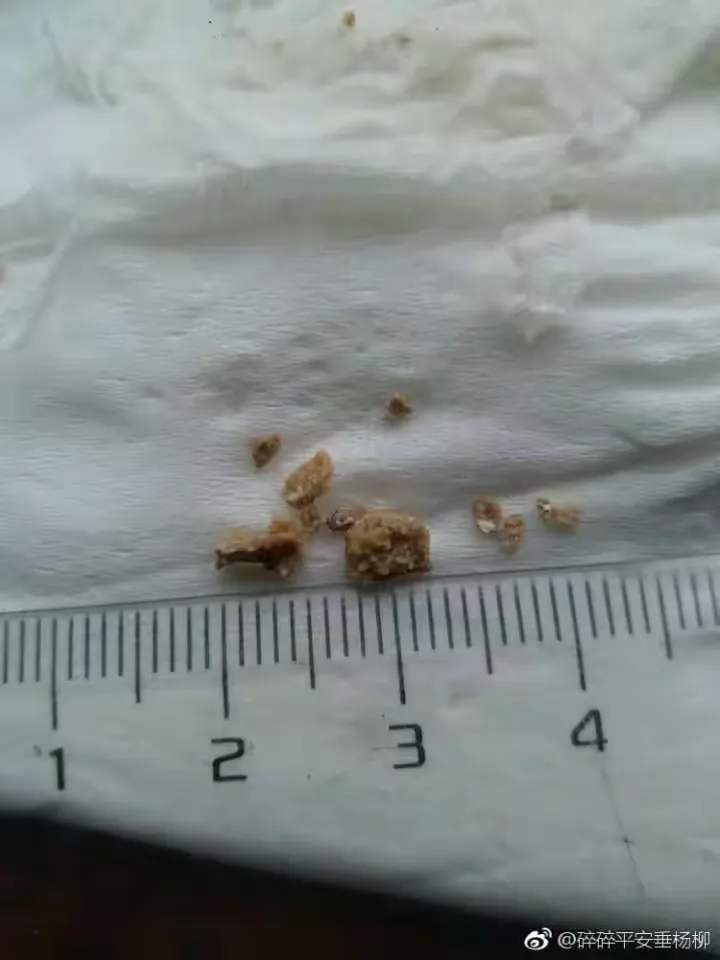 尿结石是可以排出来的，这些都是病友报的喜[微笑][微笑]不能排出的结石，就可以采用微创手术取石了！