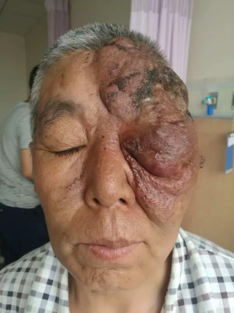 面部血管瘤一例