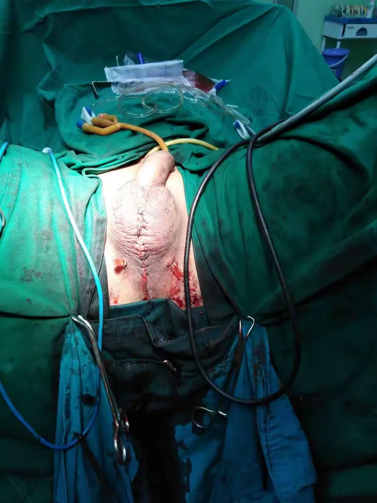 尿道球部远端1cm断裂吻合术一例