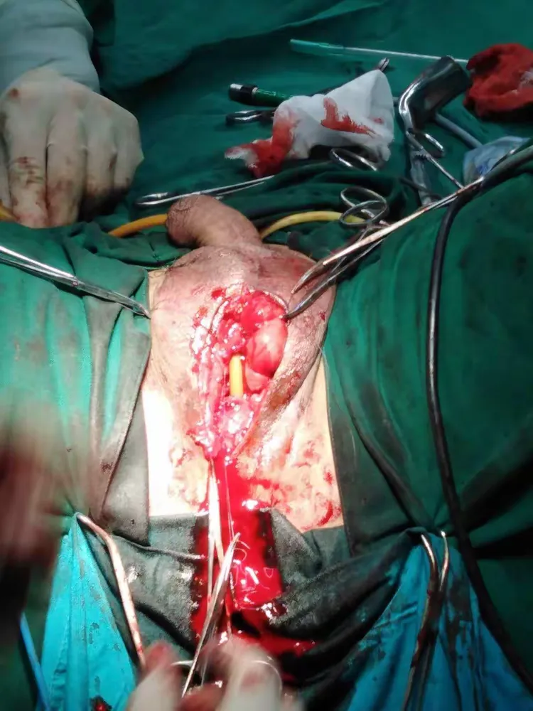 尿道球部远端1cm断裂吻合术一例