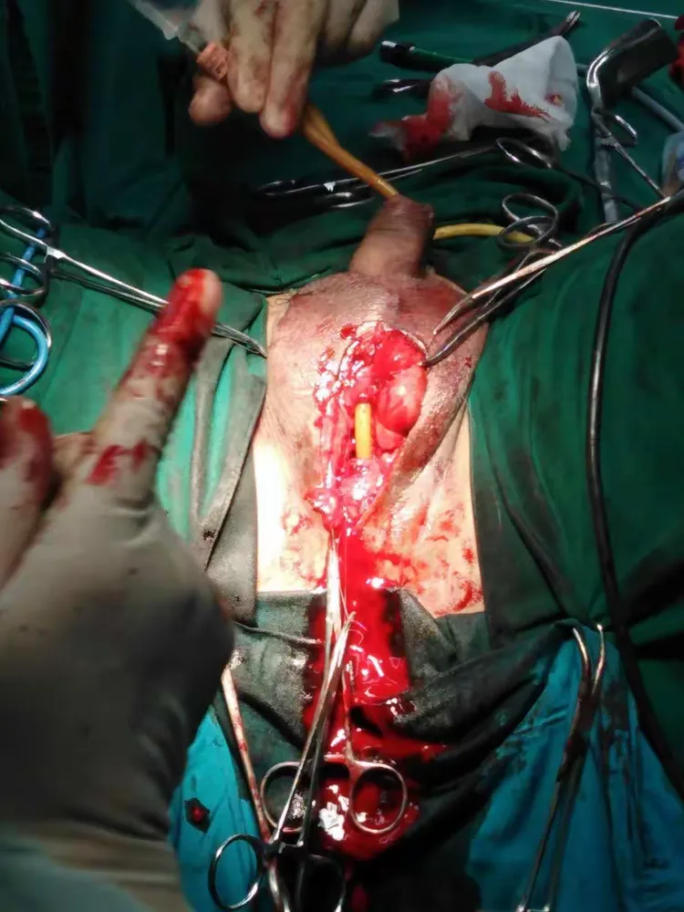 尿道球部远端1cm断裂吻合术一例