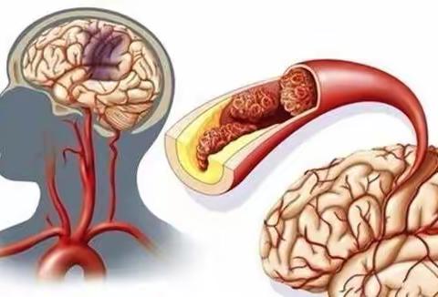 春季脑血管病高发，哪些问题需要注意？