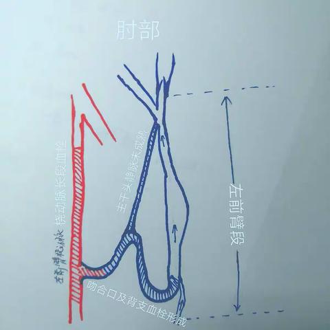 前臂AVF闭塞动脉取栓+转位重建术