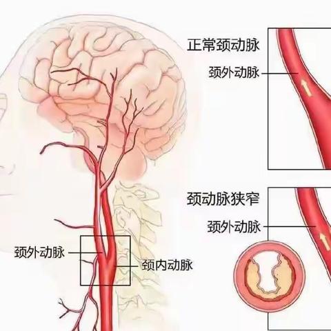 颈动脉斑块