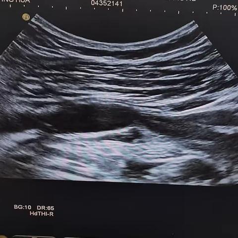 腘血管陷迫综合征（二）