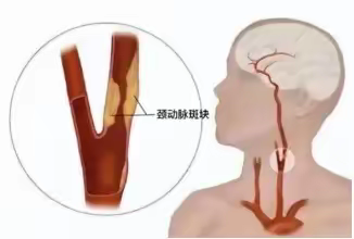 颈动脉斑块形成过程