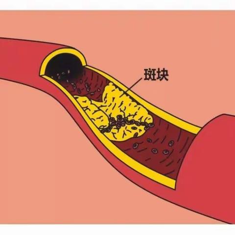 颈动脉斑块