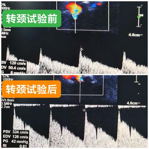 转颈试验阳性