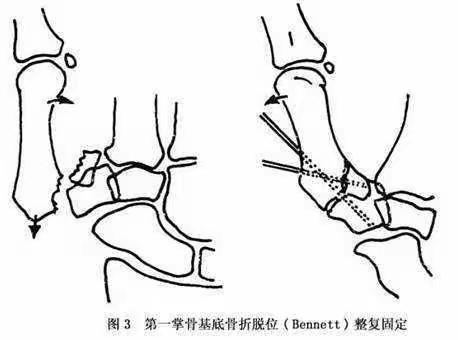 东西部医疗扶贫进行时：第一掌骨基底部骨折脱位（Bennett骨折）~手术微创治疗！