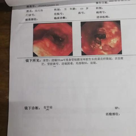 普外胸外二区完成一胸腔镜联合腹腔镜下食管癌根治术