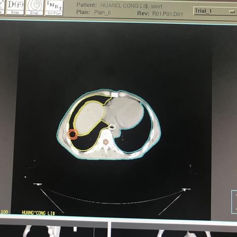 胃癌肝多发转移，SBRT，4D_CT，腹部压迫，单次1400CGYx3次，2个病灶！肝脏最大剂量20GY，V10小于50%！
