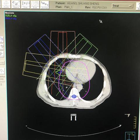 肝癌，4DCT非共面，75GY/25F，腹部压迫