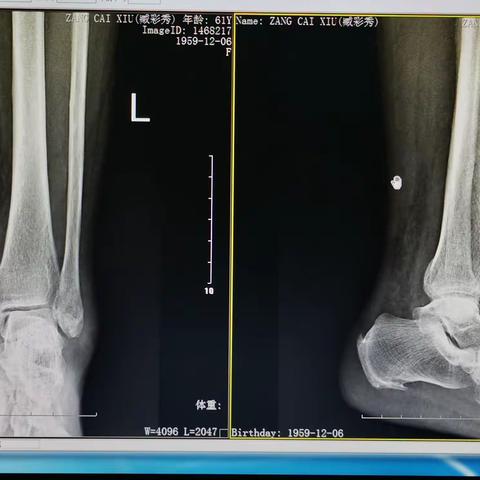 踝关节骨折的非手术疗法