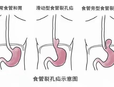 腹腔镜治疗食管裂孔疝、胃食管反流病