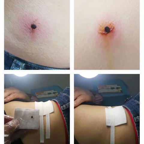 夏季来了，要小心蜱虫哦！