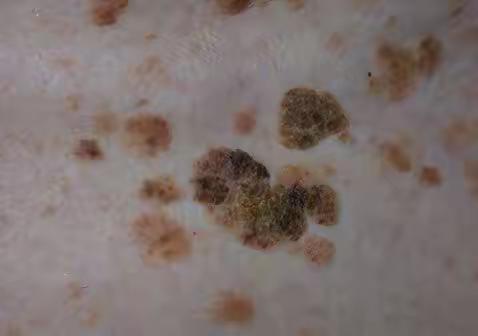 得老年斑就是老了吗？