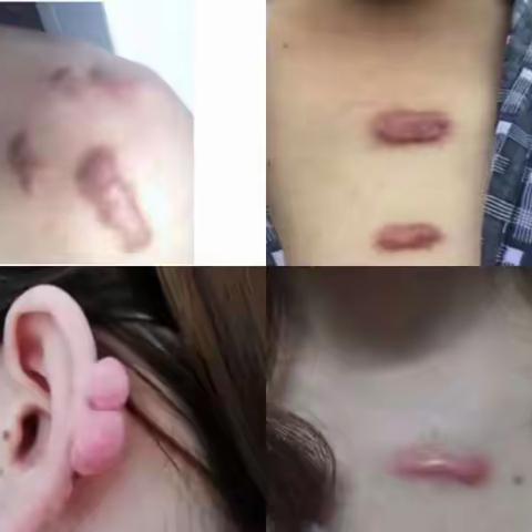 【健康你我他】谈“疤”色变