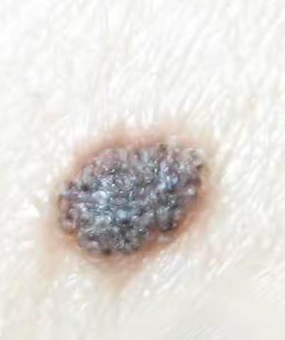 黑色素瘤小心看走眼！