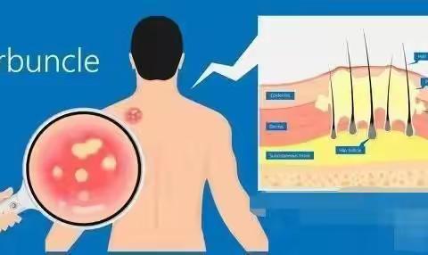 什么是脂溢性皮炎？