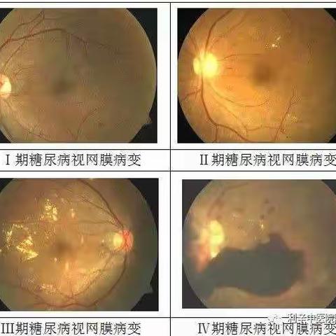 2021年糖尿病视网膜病变免费筛查