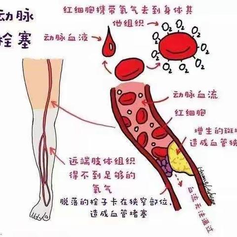 急性动脉栓塞—沉默的杀手！