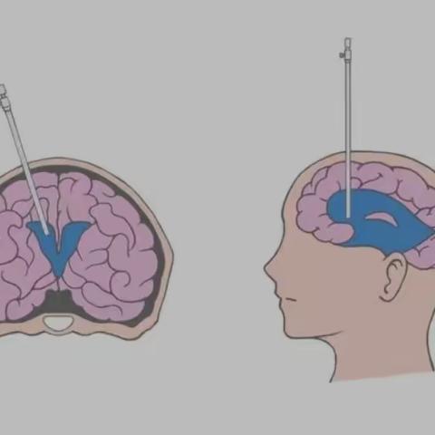 脑室内出血的神经内镜治疗