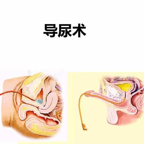 导尿术及留置尿管护理