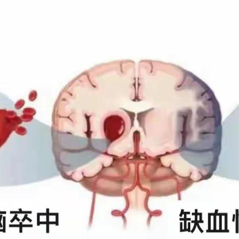 脑梗患者如何护理？神经内科护士提醒，家有脑梗患者要记住这六大护理要点