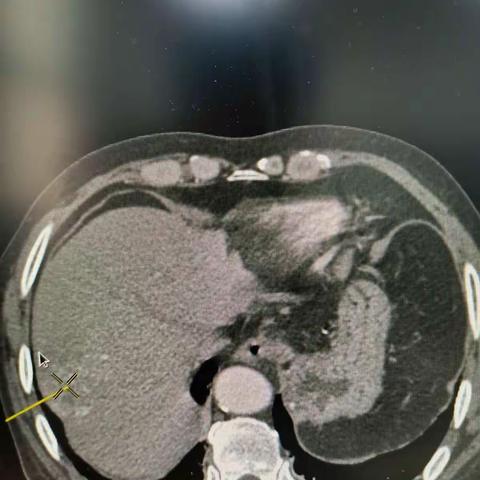 我科顺利完成一例高龄肝穿刺活检