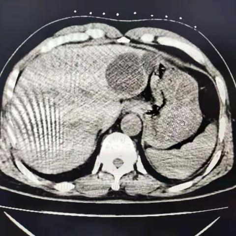 我科完成一例复杂肝囊肿穿刺硬化